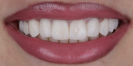 tooth1-after