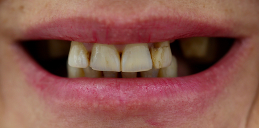 tooth2-before tooth2-before